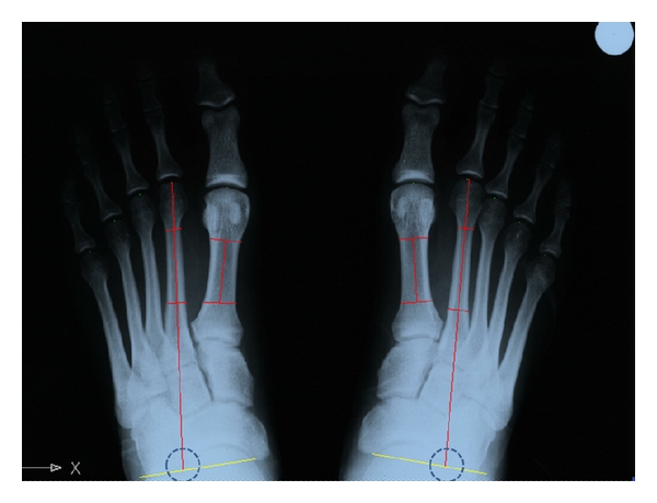 Normal Values of Metatarsal Parabola Arch