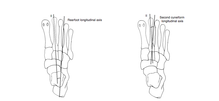 Metatarsus Adductus Angle in Male and Female Feet
