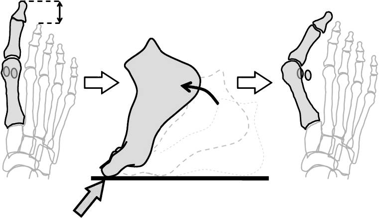 Length of the first metatarsal and hallux in hallux valgus in the initial stage