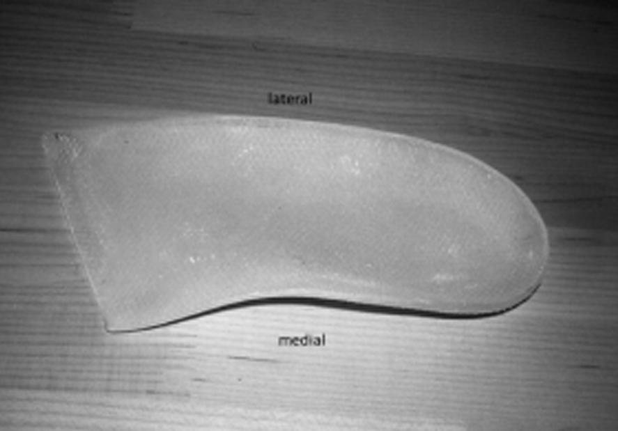 Orthotic Devices with Out-toeing Wedge as Treatment for In-toed Gait in Children